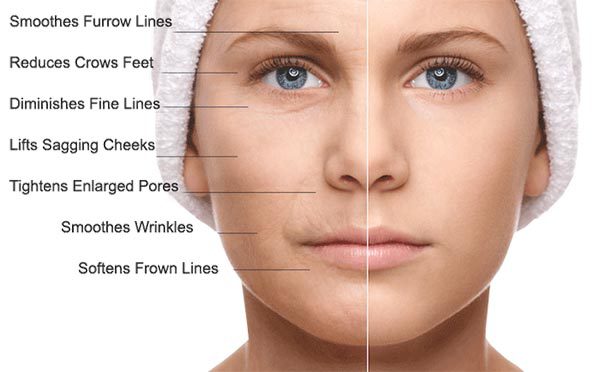 dermapen-dermaroller-microneedling-benefit