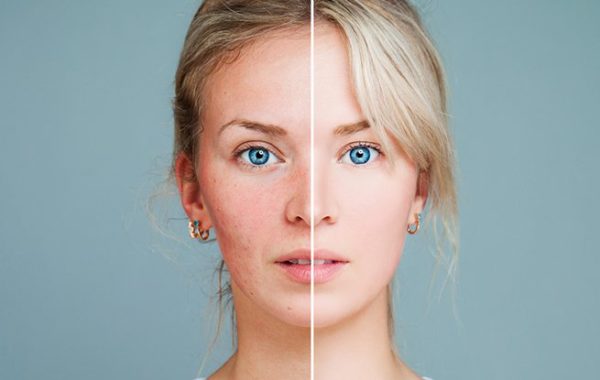 microneedling-dermapen-dermaroller-before-after