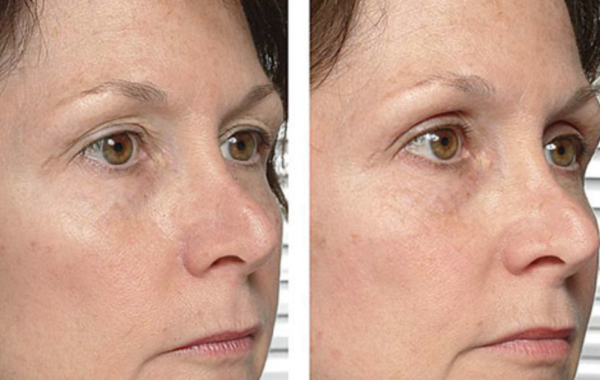 rf-radio-frequency-setrik-wajah-before-after
